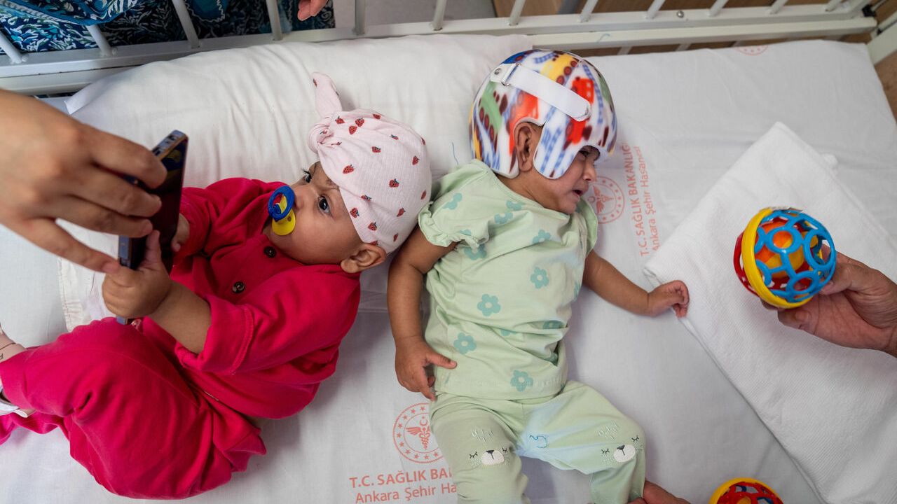 Yapışık ikizler Türkiye'deki operasyonla ayrıldı