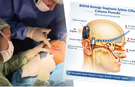 Balıkesir’de İlk Kez Uygulandı: Kemiğe İmplante İşitme Cihazı Umut Oldu