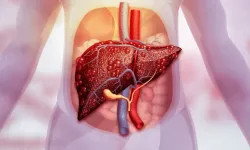Yağlı karaciğer tehlikesi büyüyor! Her 3 kişiden biri risk altında