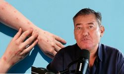 Gazeteci Serdar Akinan Dang Hummasına Yakalandı! Dang Humması Ölümcül mü? Bulaşıcı mı?