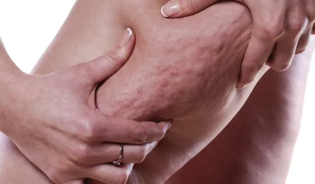 Kadınların Sessiz Düşmanı: Lipödem