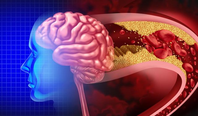 Anevrizma Nedir? Beyin Anevrizması Belirtileri, Nedenleri ve Tedavi Yöntemleri