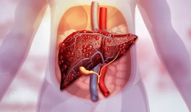 Yağlı karaciğer tehlikesi büyüyor! Her 3 kişiden biri risk altında