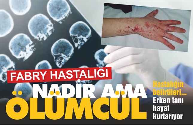 Yanma, Ağrı, Böbrek Yetmezliği… Fabry Hastalığı Sessizce İlerliyor